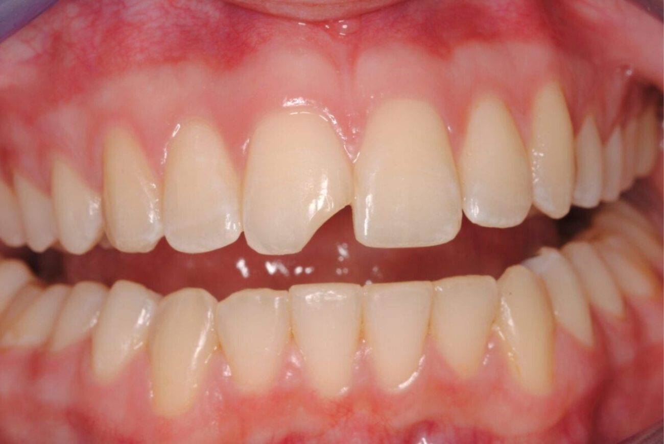 before cosmetic dentistry in Alpharetta, GA