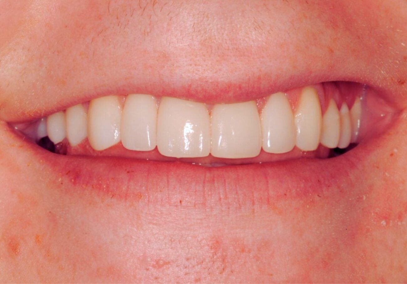 after cosmetic dentistry in Alpharetta, GA