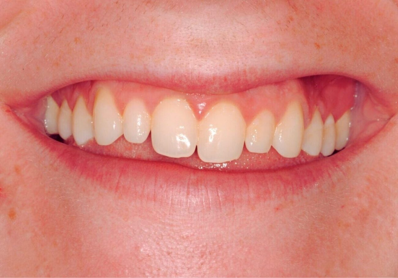 before cosmetic dentistry in Alpharetta, GA