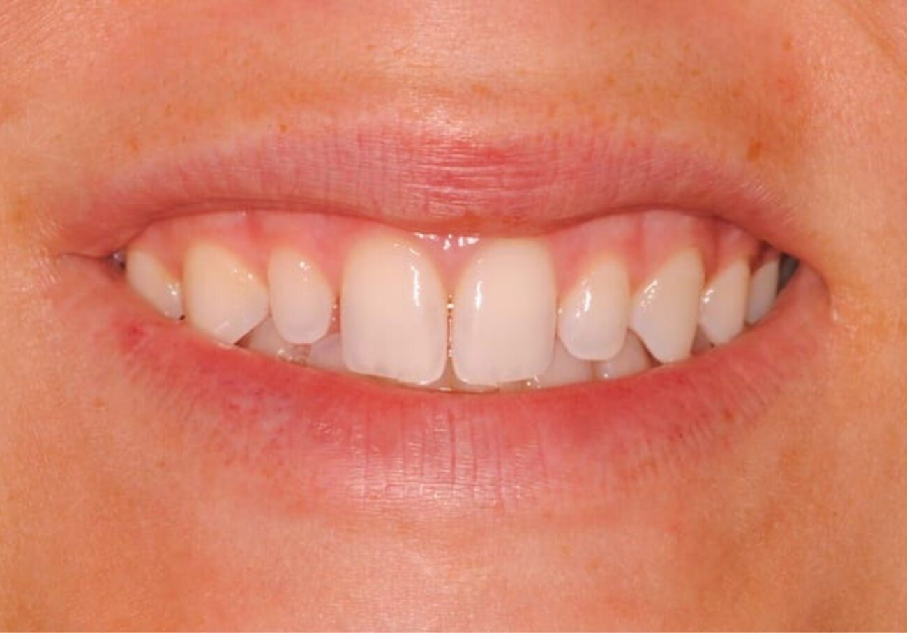 before cosmetic dentistry in Alpharetta, GA