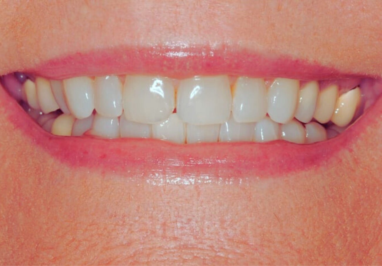 before cosmetic dentistry in Alpharetta, GA