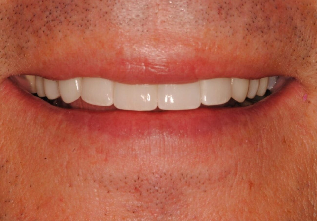 after cosmetic dentistry in Alpharetta, GA