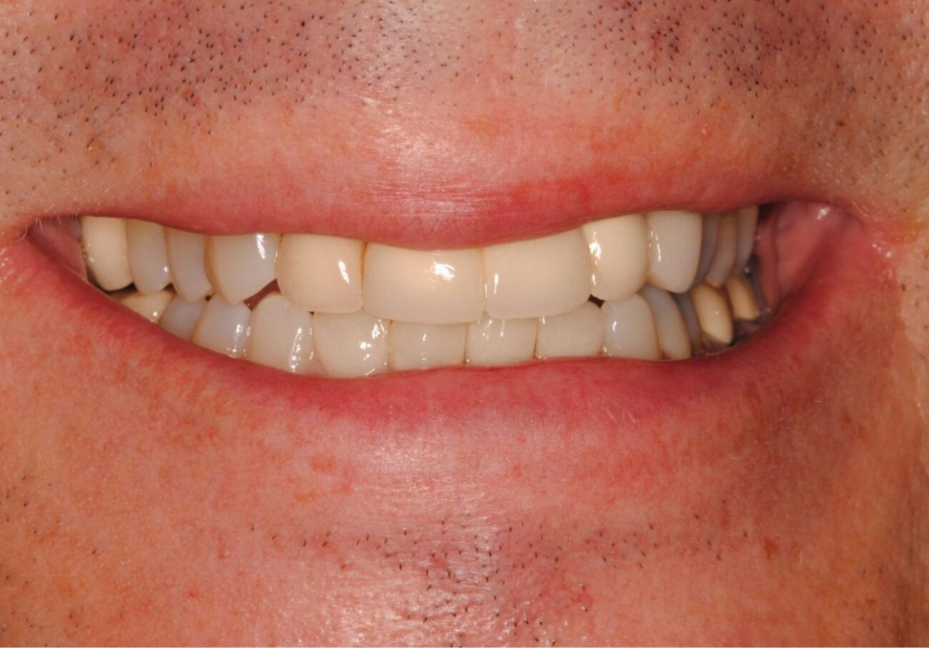 before cosmetic dentistry in Alpharetta, GA
