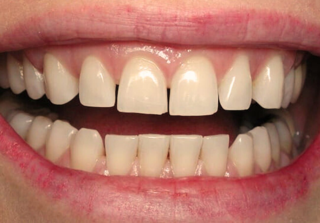 before cosmetic dentistry in Alpharetta, GA