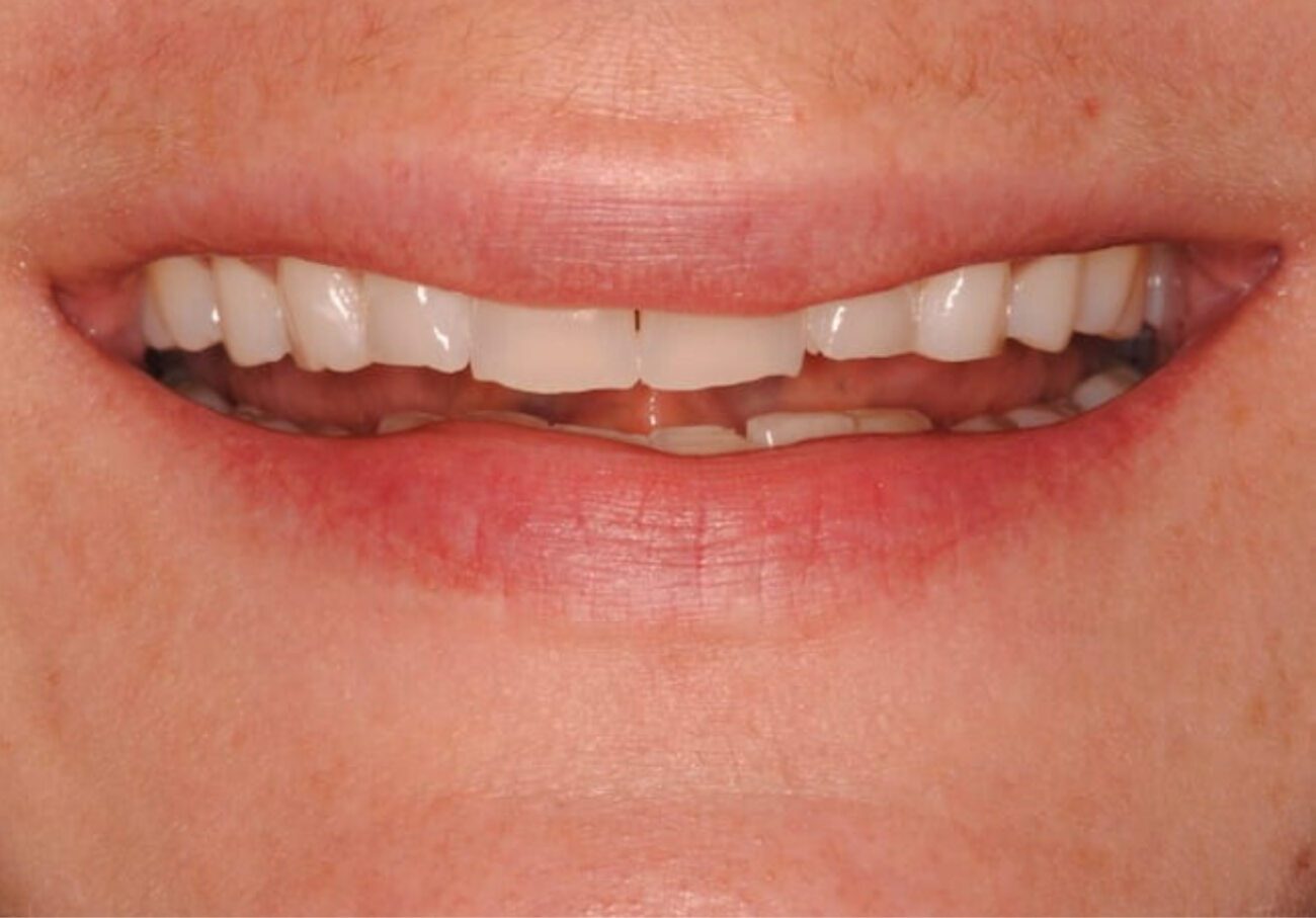 before cosmetic dentistry in Alpharetta, GA