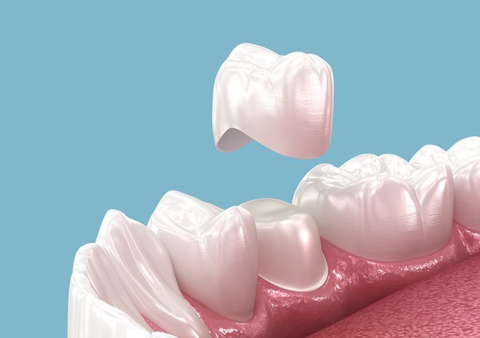 getting dental crowns in alpharetta, georgia